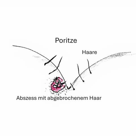 Steißbeinfistel schematisch